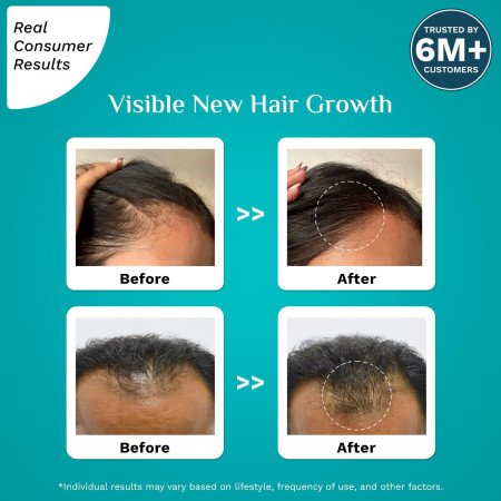 Pilgrim Redensyl 3% + Anagain 4% Advanced Hair Growth Serum (50ml) with Natural Ingredients, Controls Hair Fall, Stimulates Hair